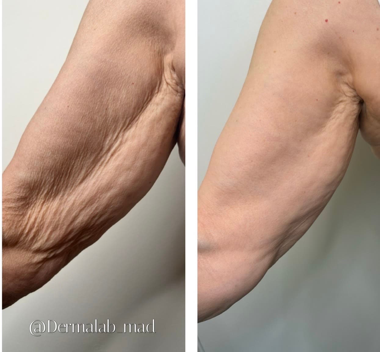 Antes y después de Plasma Fibroblast en la cara interna del brazo