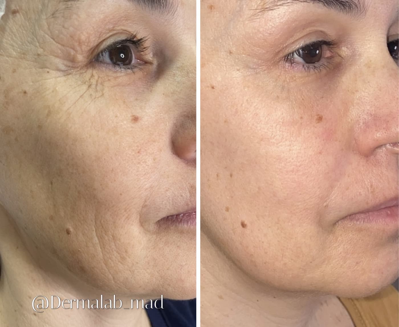 Antes y después de Plasma Fibroblast en cara completa en Dermalab