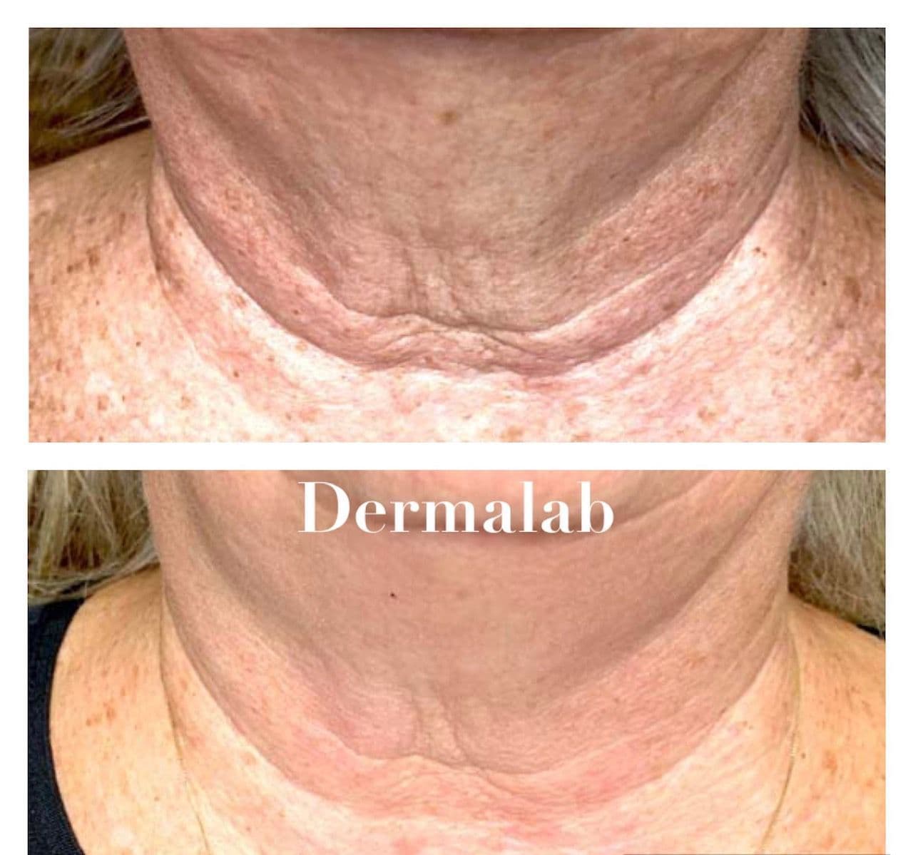 Antes y después de Plasma Fibroblast en la piel del cuello en Dermalab