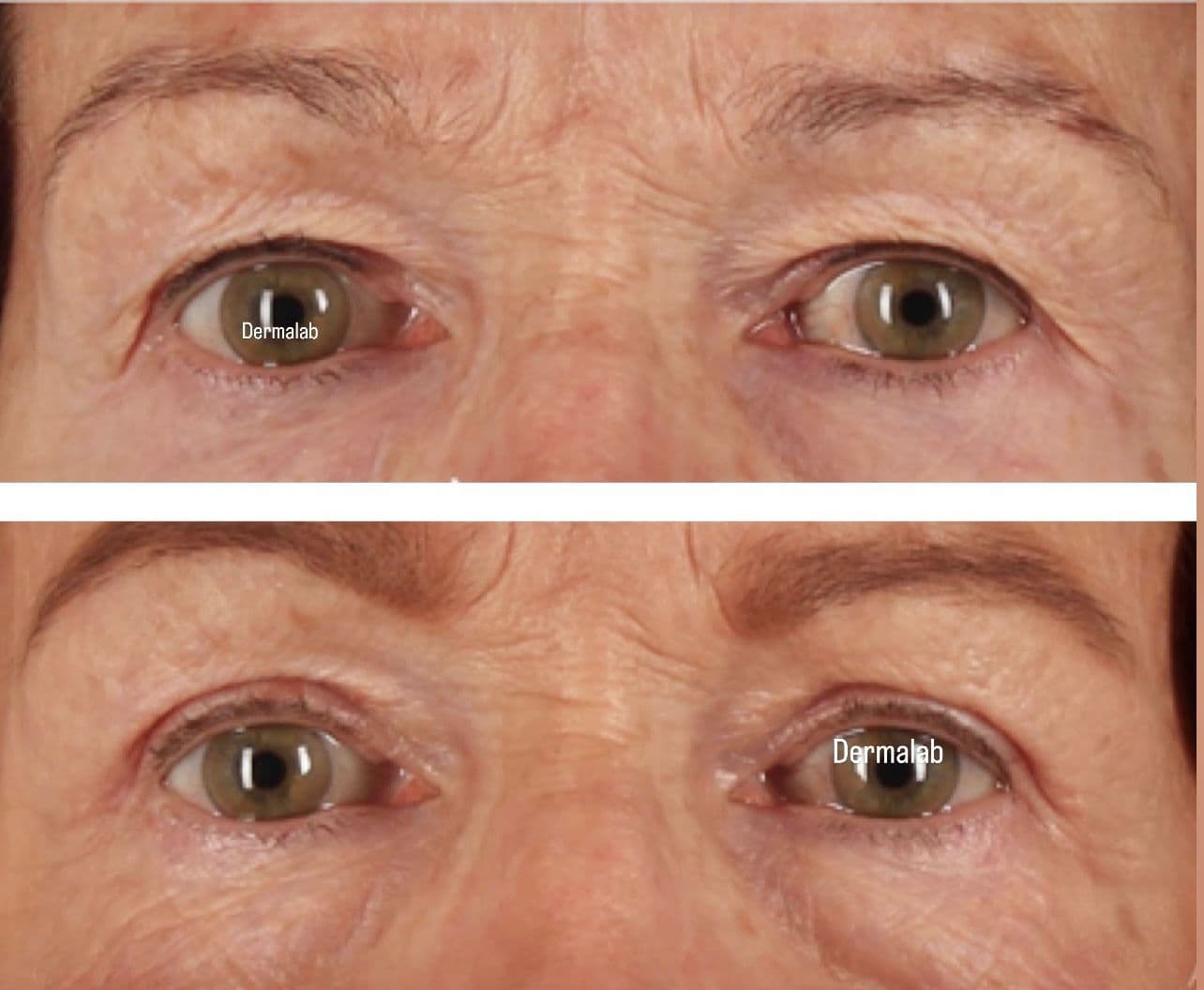 Antes y después de Plasma Fibroblast en párpados en Dermalab