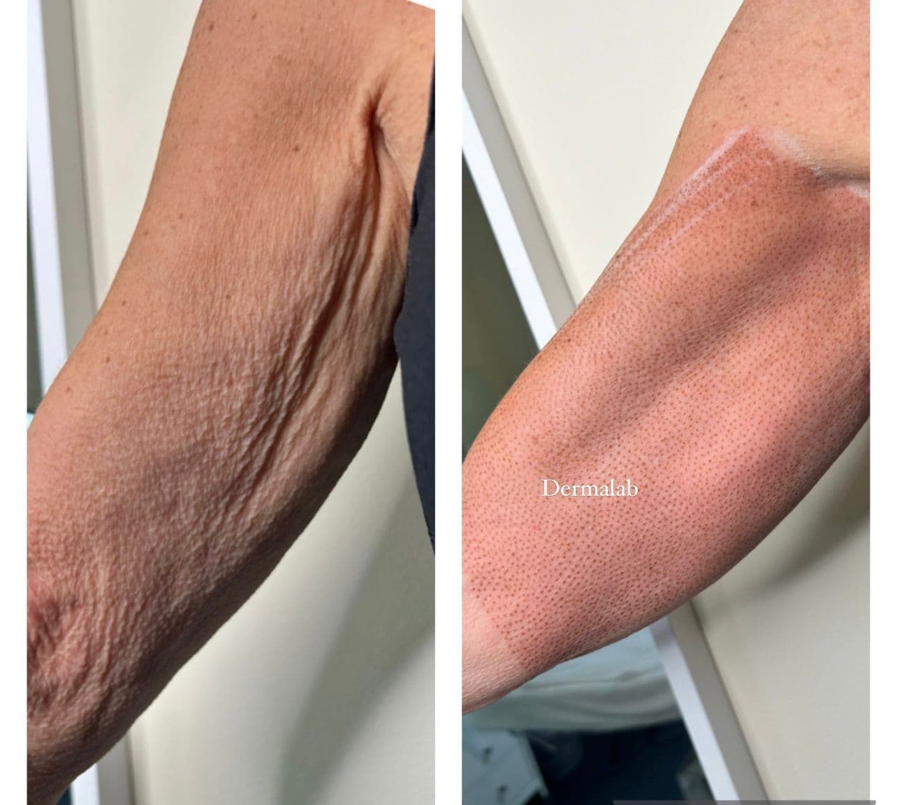 Antes y después de tratamiento de rejuvenecimiento en Dermalab Madrid (33)