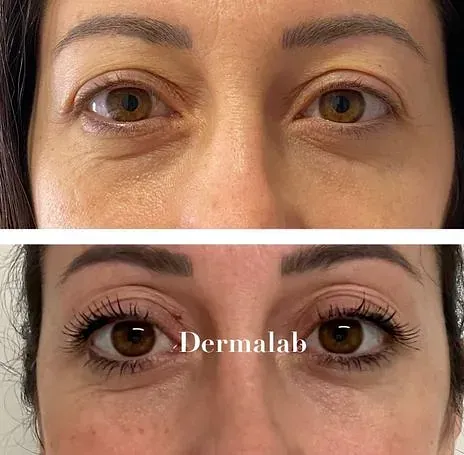 Antes y después de tratamiento de rejuvenecimiento en Dermalab Madrid (20)