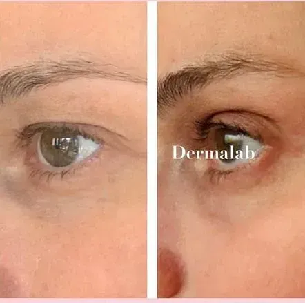 Antes y después de tratamiento de rejuvenecimiento en Dermalab Madrid (18)