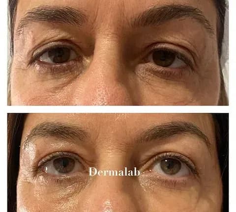 Antes y después de tratamiento de rejuvenecimiento en Dermalab Madrid (13)