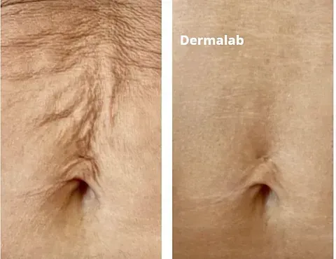 Antes y después de tratamiento de rejuvenecimiento en Dermalab Madrid (9)
