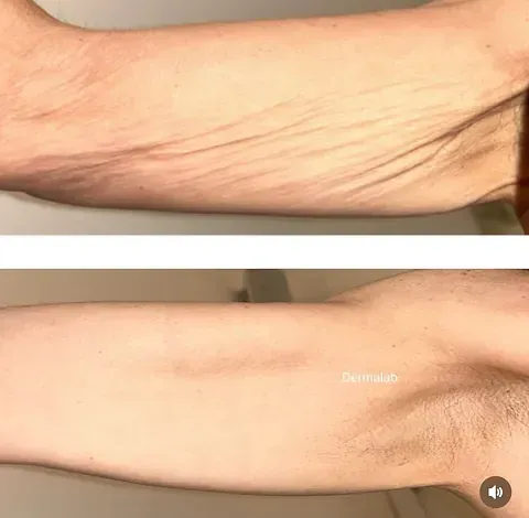 Antes y después de tratamiento de rejuvenecimiento en Dermalab Madrid (8)